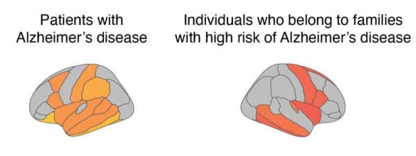 New l<em></em>ink between increased astrocytes in the brain and blood in early Alzheimer's disease